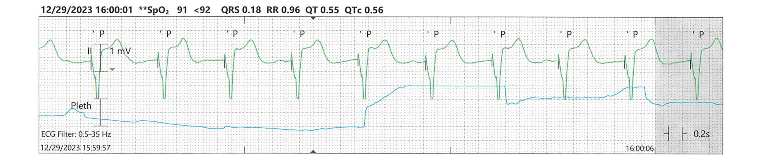 Pacemaker Histogram Pacemaker Basics - Straight A Nursing